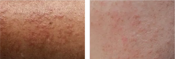 Allergiás reakciók fényképei különböző bőrtónusokon