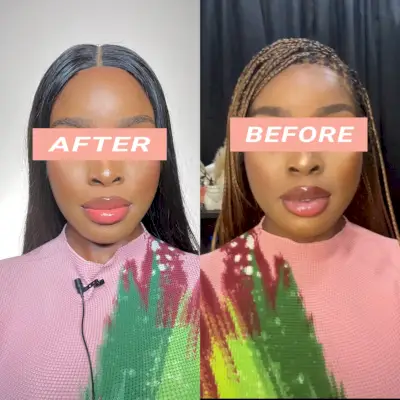 Masseter Botoks öncesi ve sonrası fotoğrafı
