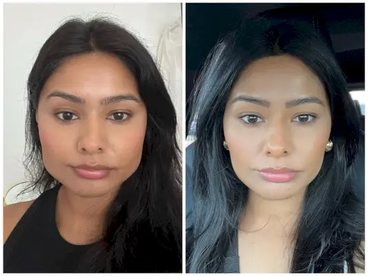 Masseter botoksunun öncesi ve sonrası fotoğrafı