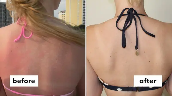 Antes y después de Emily Rekstis