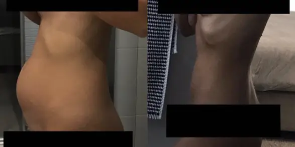 Dessa chockerande bilder visar hur en sprucken cysta på äggstockarna kan se ut