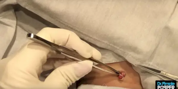 Najnovejša odstranitev ciste dr. Pimplea Popperja je hkrati odvratna in fascinantna