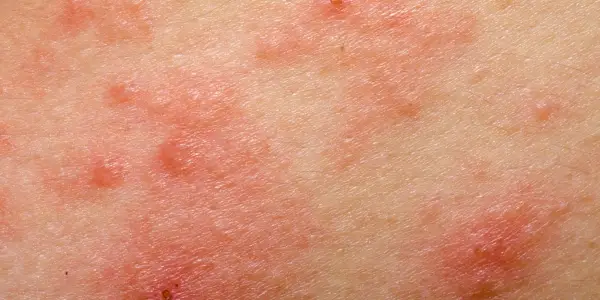 5 typů ekzému, které byste měli znát, protože jich je ve skutečnosti víc než jeden