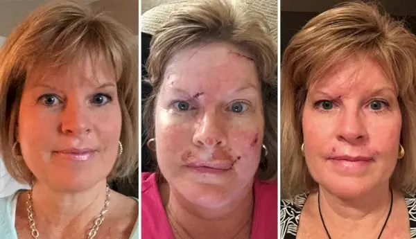 Deze vrouw deelde onbewerkte foto's van haar herstel van huidkanker om te waarschuwen tegen bruinen