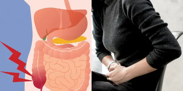 Cómo saber si su apéndice legítimo podría estallar o si es solo un fuerte dolor de estómago
