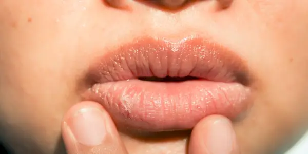 Hier leest u precies hoe u omgaat met schilferige, gebarsten lippen