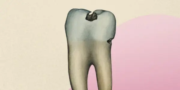 Est-il réellement possible de se débarrasser des caries sans obturation ?
