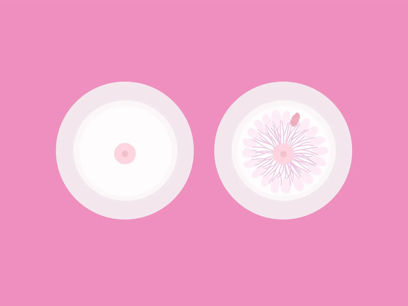 grafica del seno con macchia che suggerisce il cancro al seno