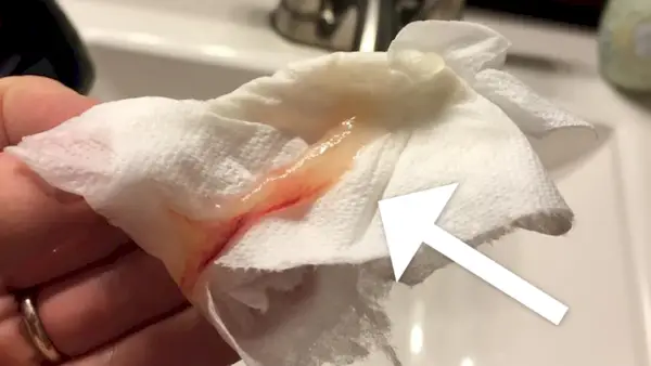 Шта је слузни чеп? Како изгледа слузни чеп? Да ли губитак слузи значи да почиње порођај? Сазнајте у овом чланку!