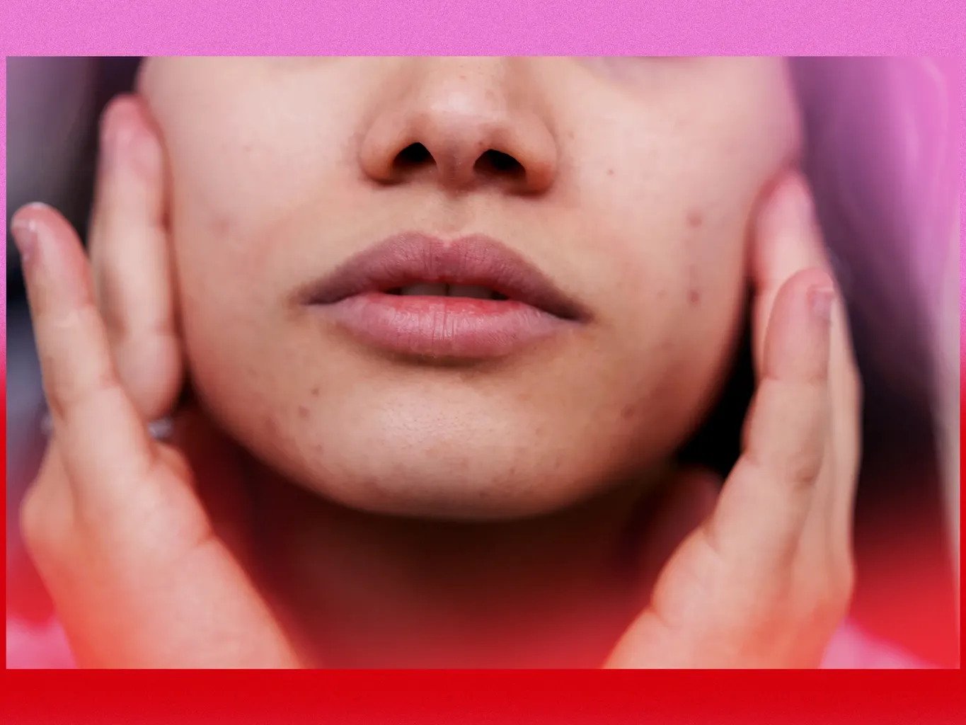 Ево како изгледају акне са ПЦОС-ом и како их лечити