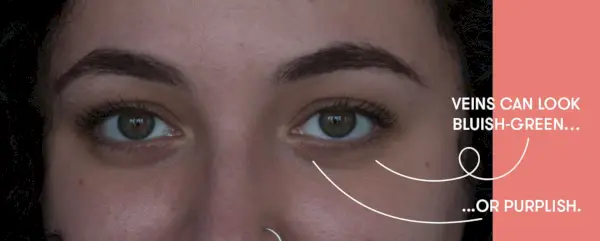 Yeux gonflés, cernes et poches : les dermatologues expliquent la différence